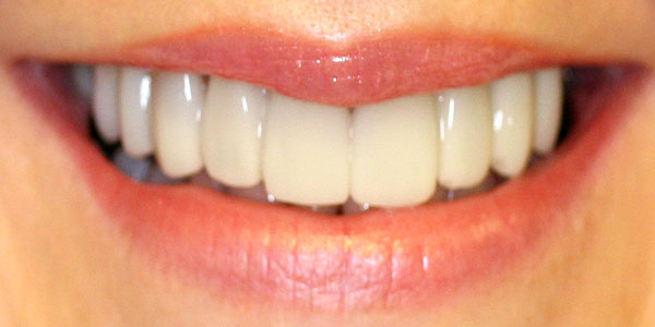 veneers Harley Street