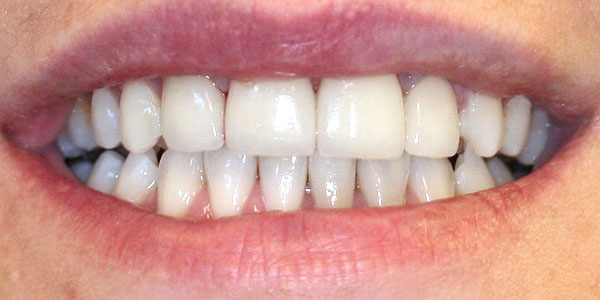 veneers Harley Street