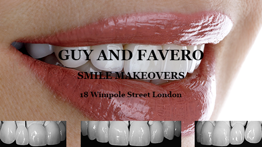 Porcelain Veneers London