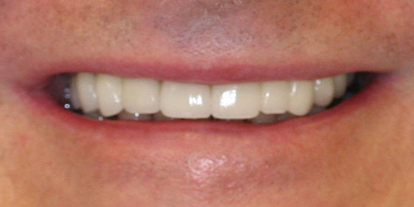 veneers Harley Street