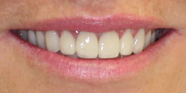 veneers Harley Street